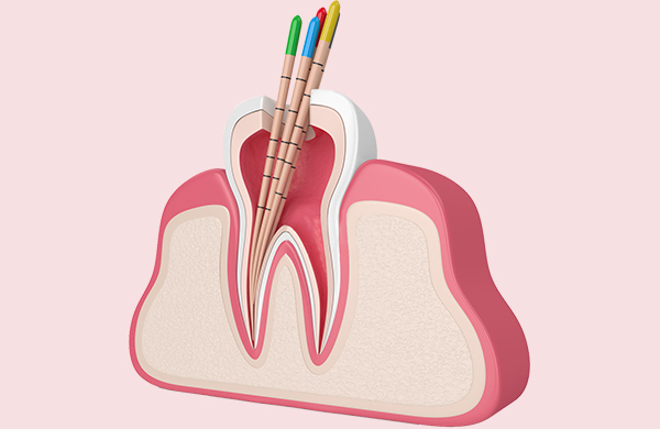 根管治疗